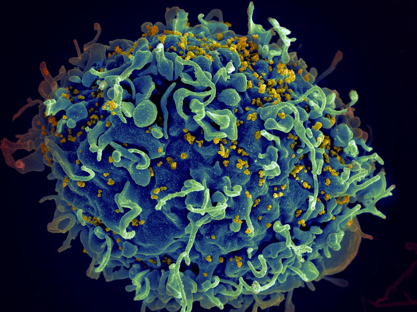 HIV, the AIDS virus, infecting a human cell