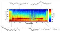 Brain waves of a patient anesthetized with propofol